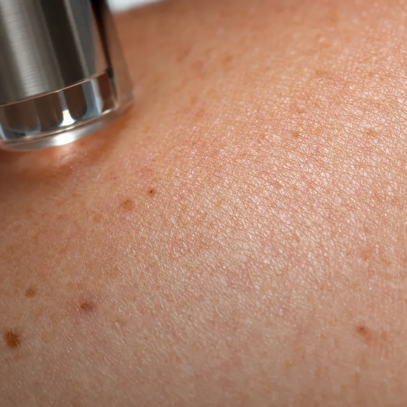 Blink Tattoo Removal